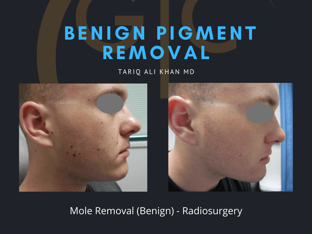 Gentle Care Laser Tustin & Long Beach Before and After picture - Mole Removal